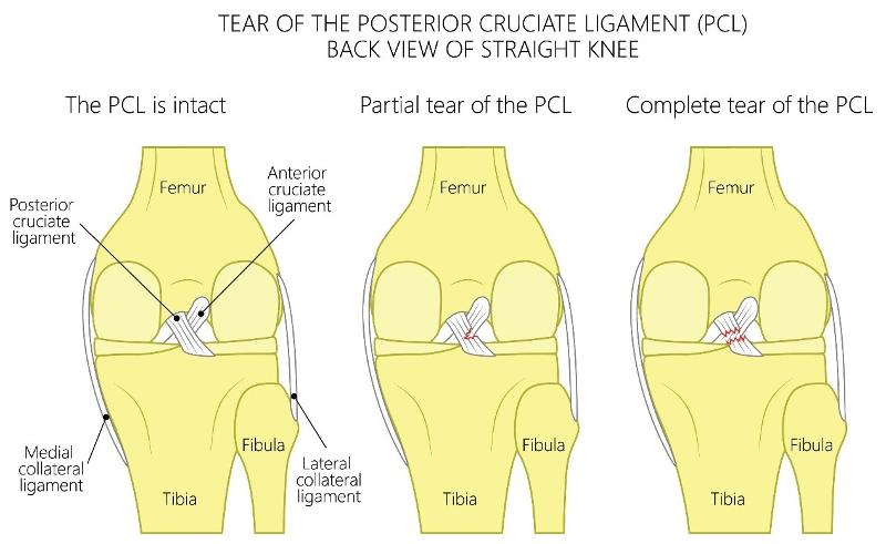 tear of the Posterior Cruciate Ligament (pcl)